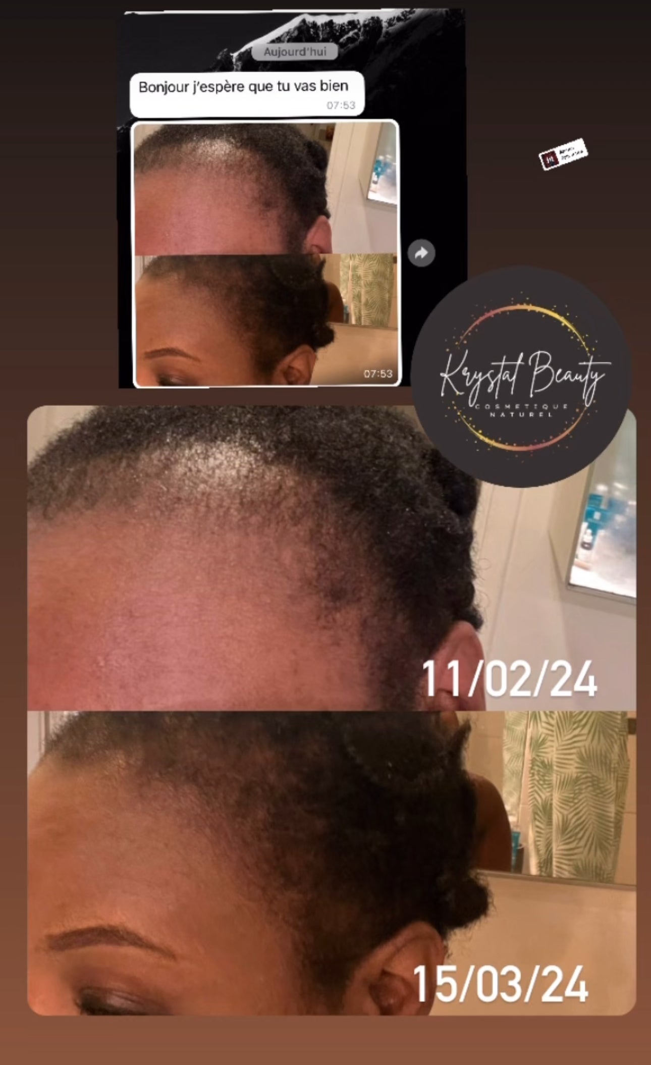 KIT ALOPECIE