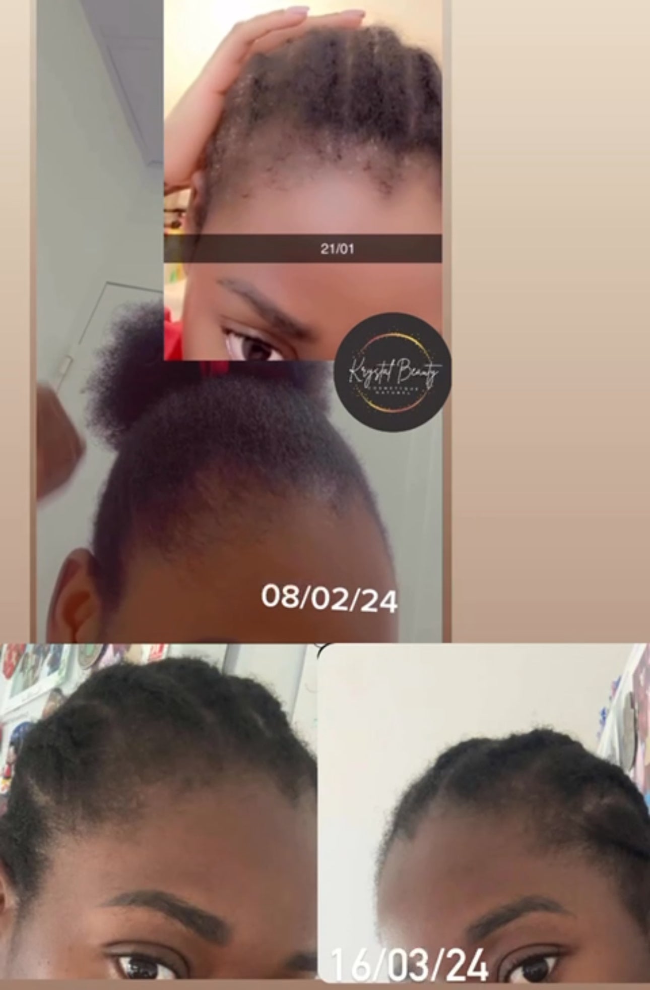KIT ALOPECIE